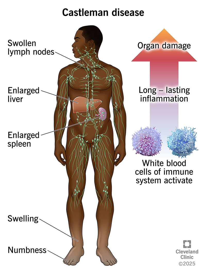 Diagnosing Castleman Disease: Why a Lymph Node Biopsy is Key